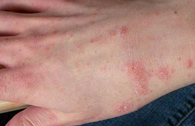 mite اثرات مایت